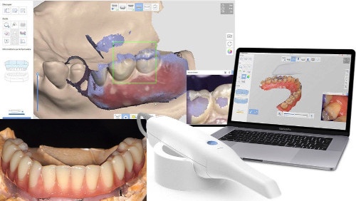 dentistes Strasbourg Empreinte-dentaire-Strasbourg-numerique