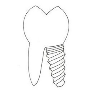 Implant Dentaire Strasbourg