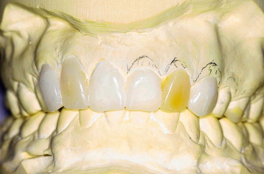 Esthétique du sourire Strasbourg Wax up