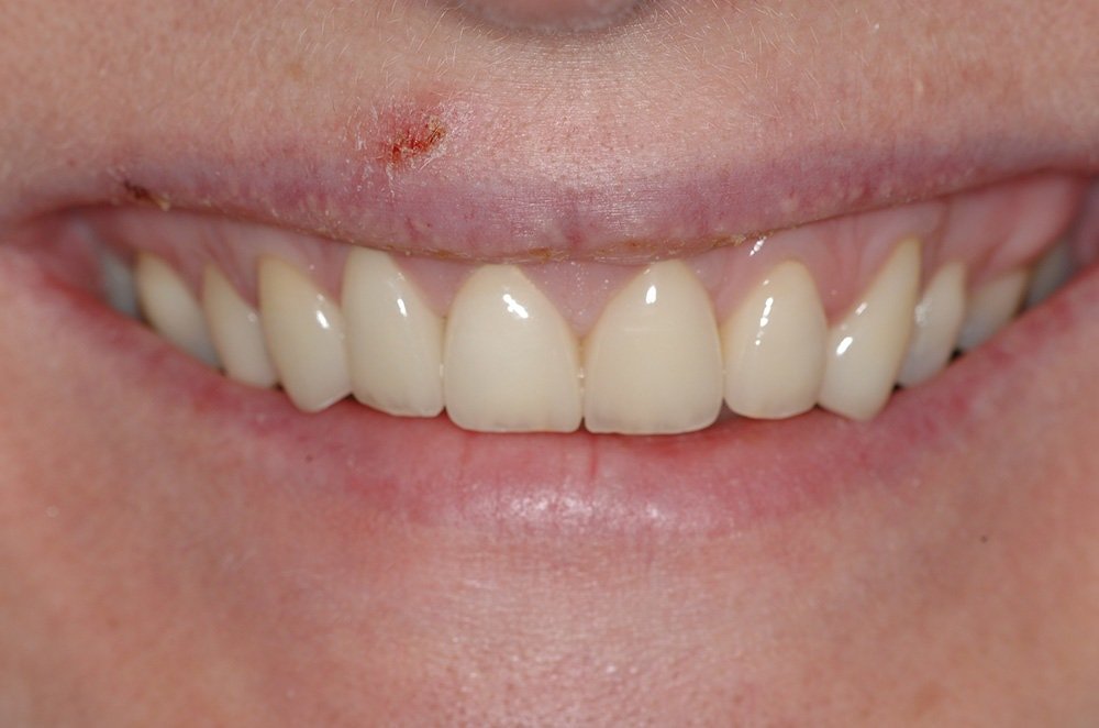 Esthétique du sourire Strasbourg couronnes E max