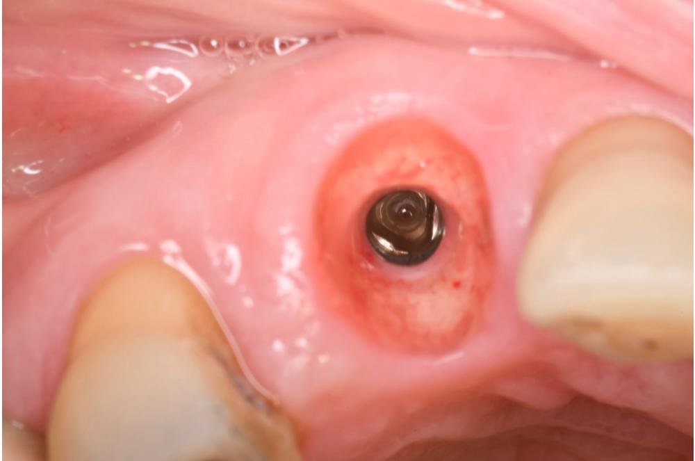 dentiste Strasbourg implantologie dentaire